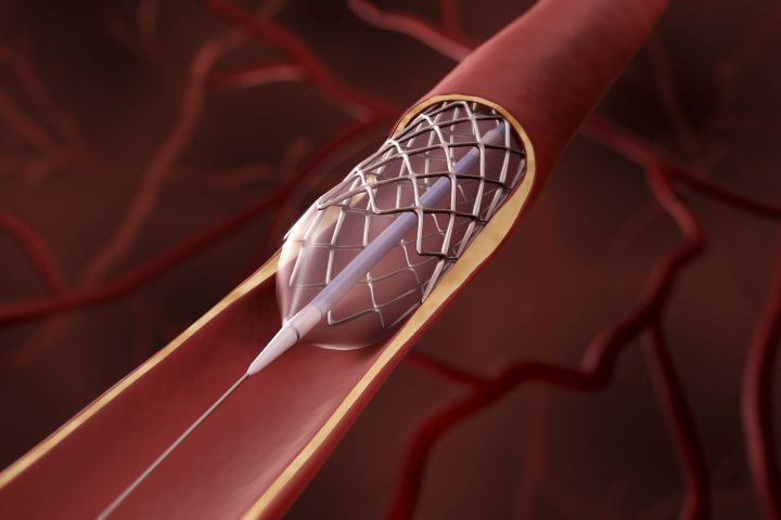 Balloon angioplasty, Stent insertion 3d illustration