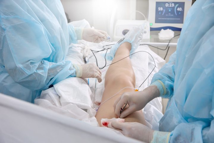 Surgeon in medical gown in operating room inserts a catheter into vein on patient's lower limb to treat varicose veins. Surgical treatment of varicose veins in hospital by a team of vascular surgeons